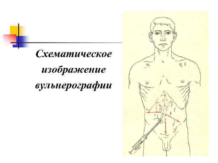 Схематическое изображение вульнерографии 