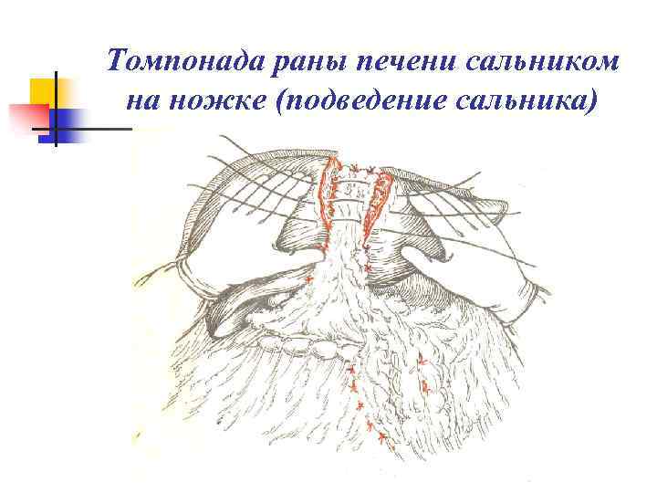 Томпонада раны печени сальником на ножке (подведение сальника) 