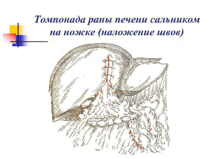 Томпонада раны печени сальником на ножке (наложение швов) 