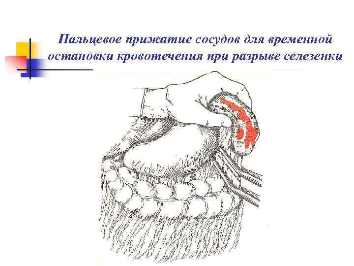 Пальцевое прижатие сосудов для временной остановки кровотечения при разрыве селезенки 