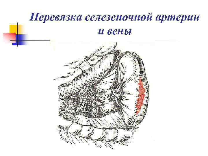 Перевязка селезеночной артерии и вены 
