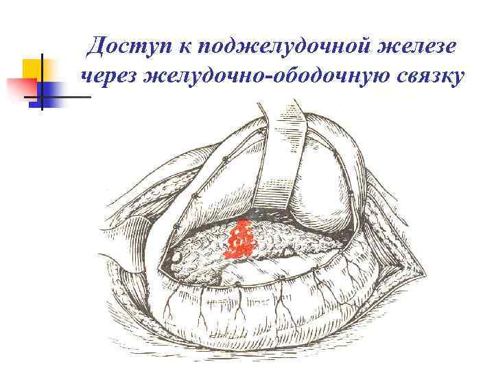 Доступ к поджелудочной железе через желудочно-ободочную связку 