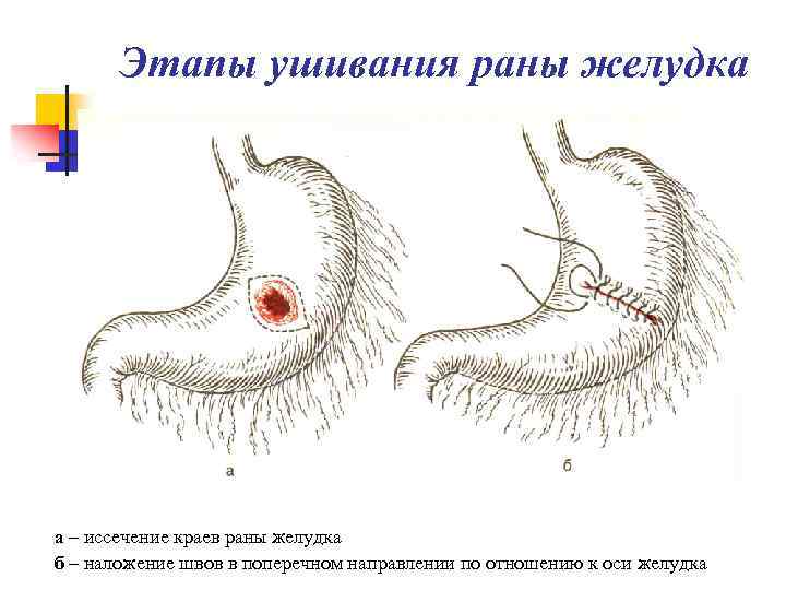 Этапы ушивания раны желудка а – иссечение краев раны желудка б – наложение швов