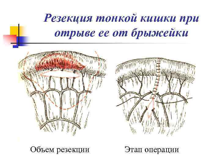 Резекция тонкой кишки при отрыве ее от брыжейки Объем резекции Этап операции 