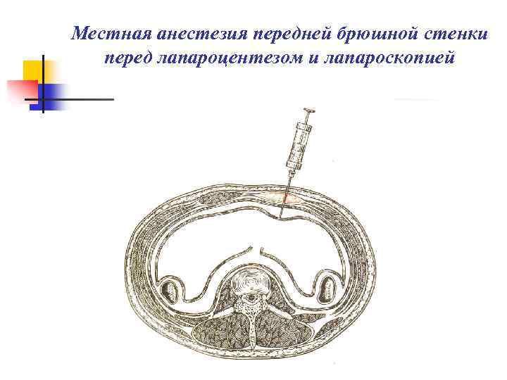Местная анестезия передней брюшной стенки перед лапароцентезом и лапароскопией 