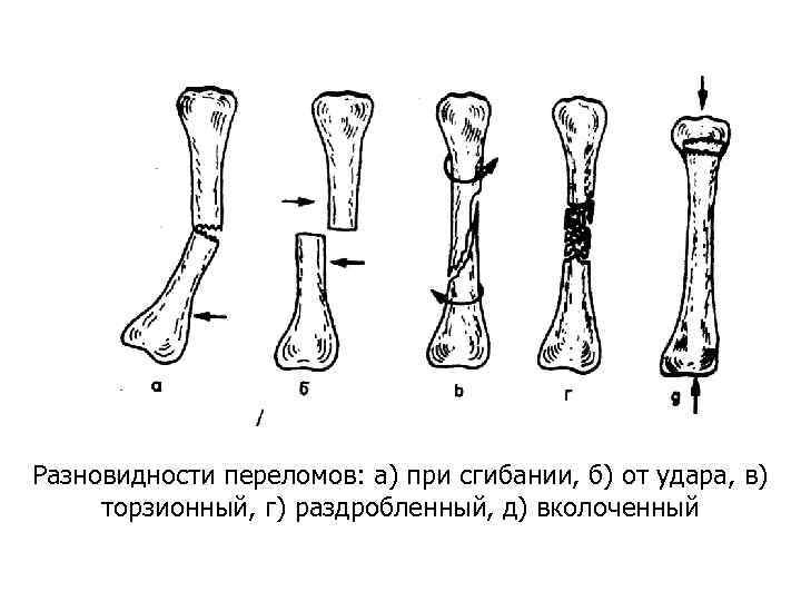 Разновидности переломов: а) при сгибании, б) от удара, в) торзионный, г) раздробленный, д) вколоченный