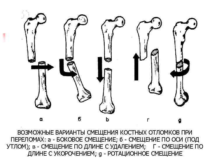 ВОЗМОЖНЫЕ ВАРИАНТЫ СМЕЩЕНИЯ КОСТНЫХ ОТЛОМКОВ ПРИ ПЕРЕЛОМАХ: а БОКОВОЕ СМЕЩЕНИЕ; б СМЕЩЕНИЕ ПО ОСИ