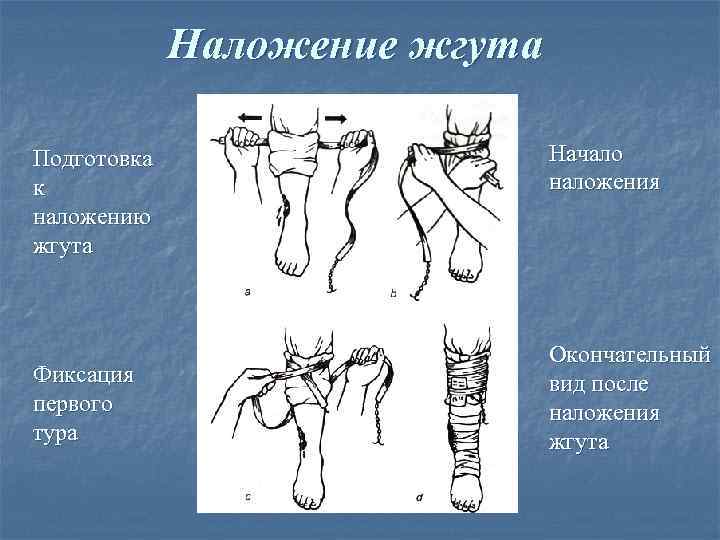 Наложение жгута Подготовка к наложению жгута Фиксация первого тура Начало наложения Окончательный вид после