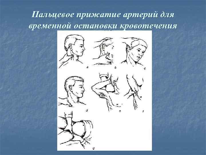 Пальцевое прижатие. Пальцевое прижатие артерий. Пальцевое прижатие артерий для временной остановки кровотечения. Пальцевое прижатие артерии обеспечивает. Точки пальцевого прижатия артерий для остановки кровотечения.