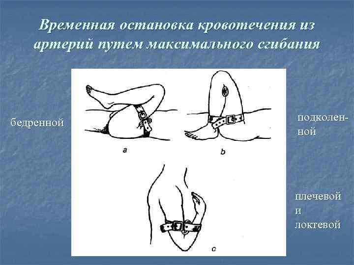 Временная остановка кровотечения из артерий путем максимального сгибания бедренной подколенной плечевой и локтевой 