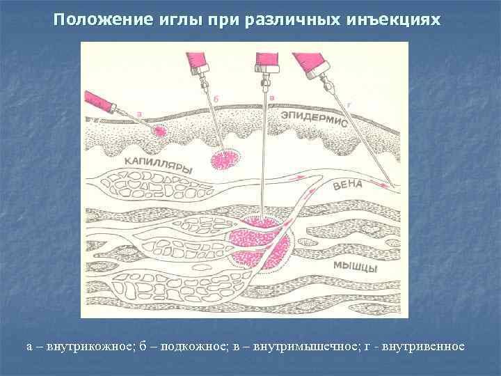 Положение иглы при различных инъекциях а – внутрикожное; б – подкожное; в – внутримышечное;