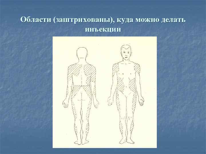 Области (заштрихованы), куда можно делать инъекции 