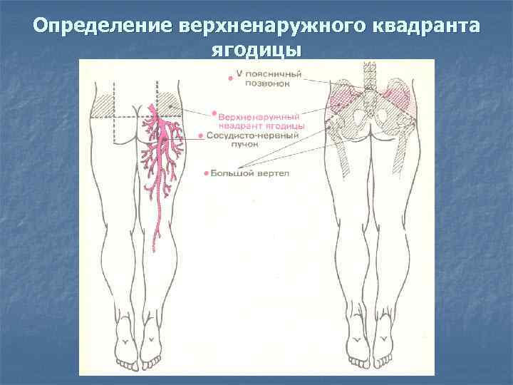 Определение верхненаружного квадранта ягодицы 