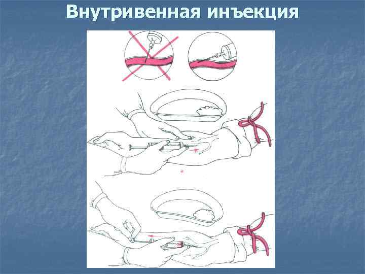 Внутривенная инъекция 