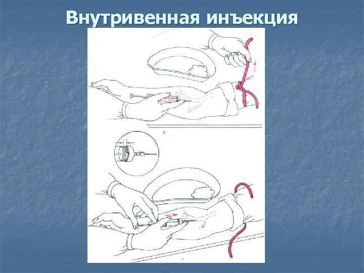 Внутривенная инъекция 