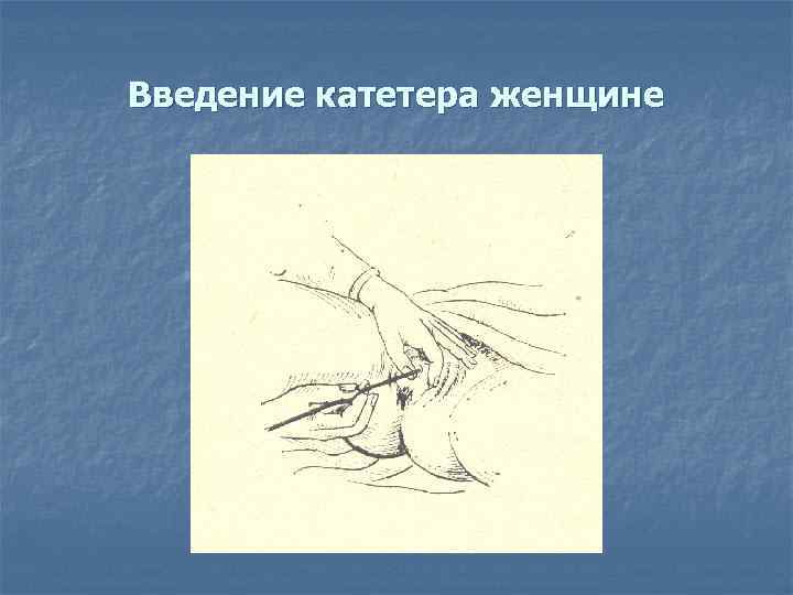 Введение катетера женщине 