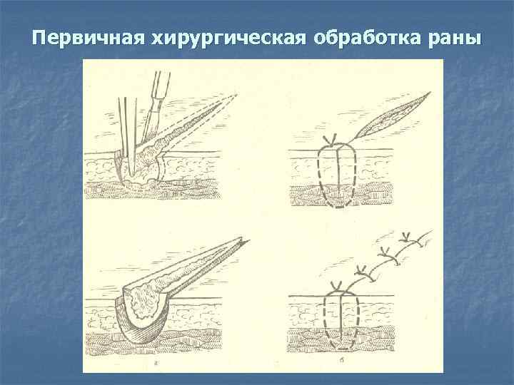 Первичная хирургическая обработка раны 