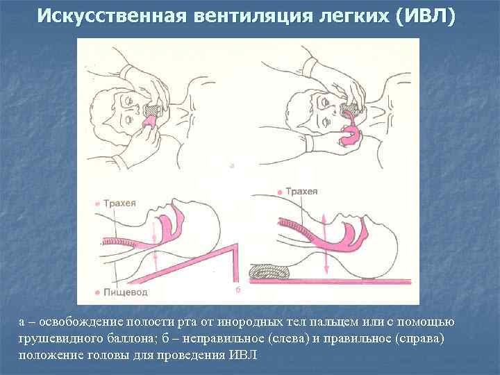 Искусственная вентиляция легких (ИВЛ) а – освобождение полости рта от инородных тел пальцем или