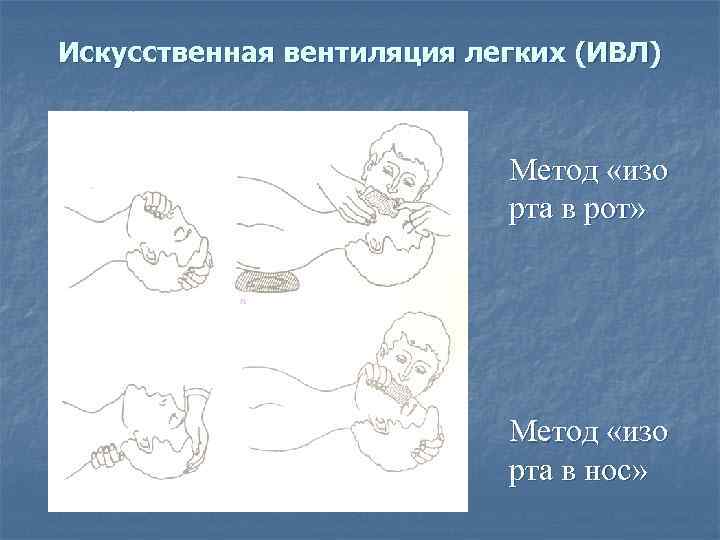 Искусственная вентиляция легких (ИВЛ) Метод «изо рта в рот» Метод «изо рта в нос»