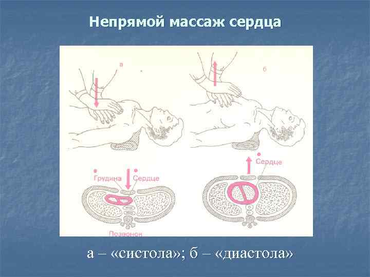 Непрямой массаж сердца а – «систола» ; б – «диастола» 