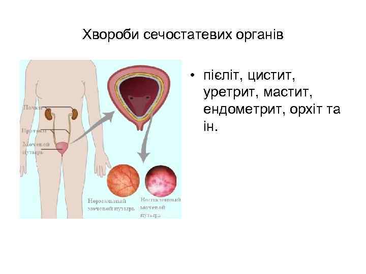 Хвороби сечостатевих органів • пієліт, цистит, уретрит, мастит, ендометрит, орхіт та ін. 