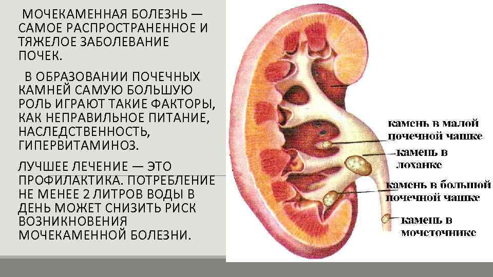 Мочекаменная болезнь у детей презентация