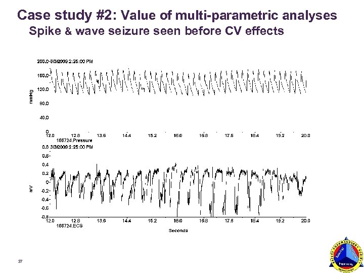 Case study #2: Value of multi-parametric analyses Spike & wave seizure seen before CV
