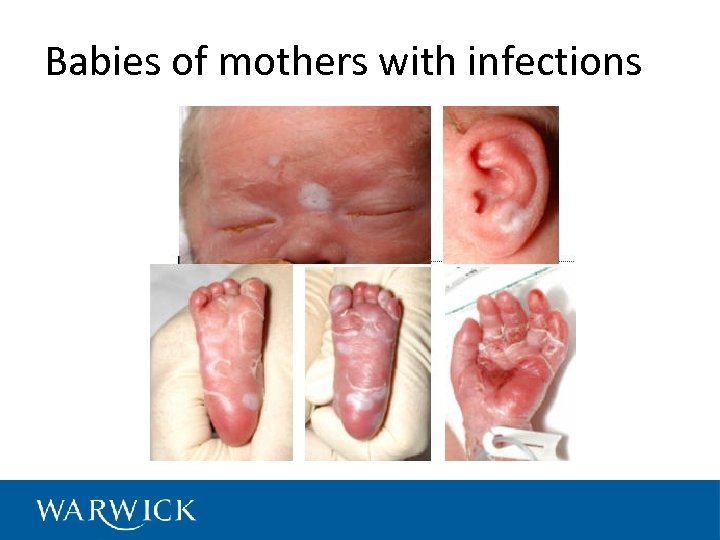 Babies of mothers with infections 