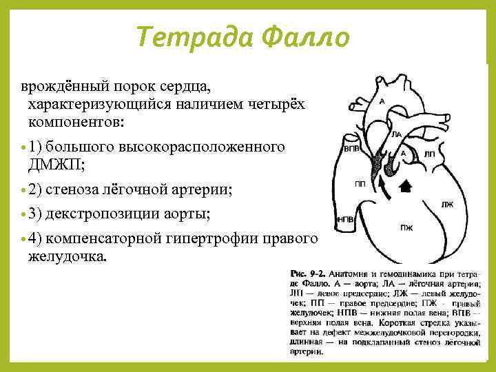 Тетрада Фалло врождённый порок сердца, характеризующийся наличием четырёх компонентов: • 1) большого высокорасположенного ДМЖП;