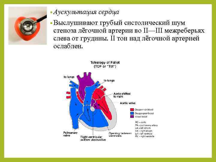  • Аускультация сердца • Выслушивают грубый систолический шум стеноза лёгочной артерии во II—III