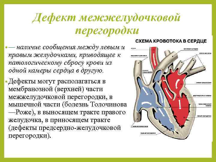 Дефект межжелудочковой перегородки • — наличие сообщения между левым и правым желудочками, приводящее к