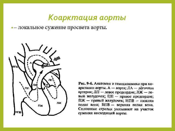 Коарктация аорты • – локальное сужение просвета аорты. 