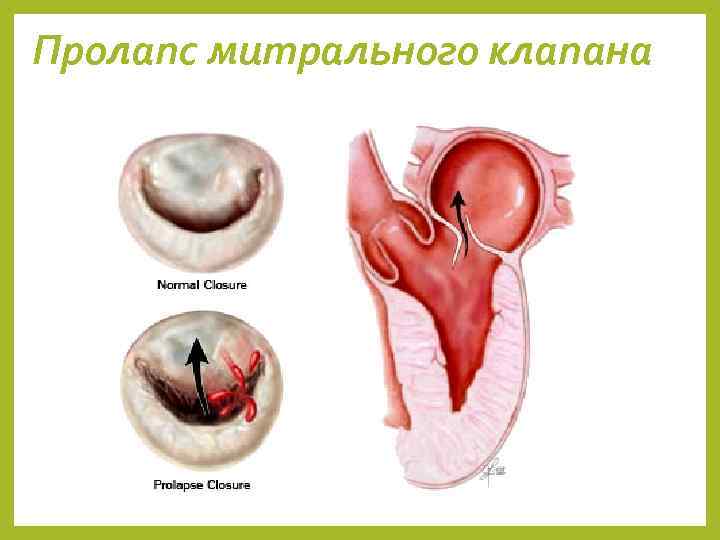 Пролапс митрального клапана 