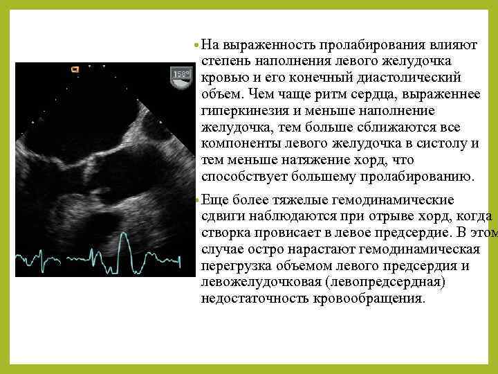  • На выраженность пролабирования влияют степень наполнения левого желудочка кровью и его конечный