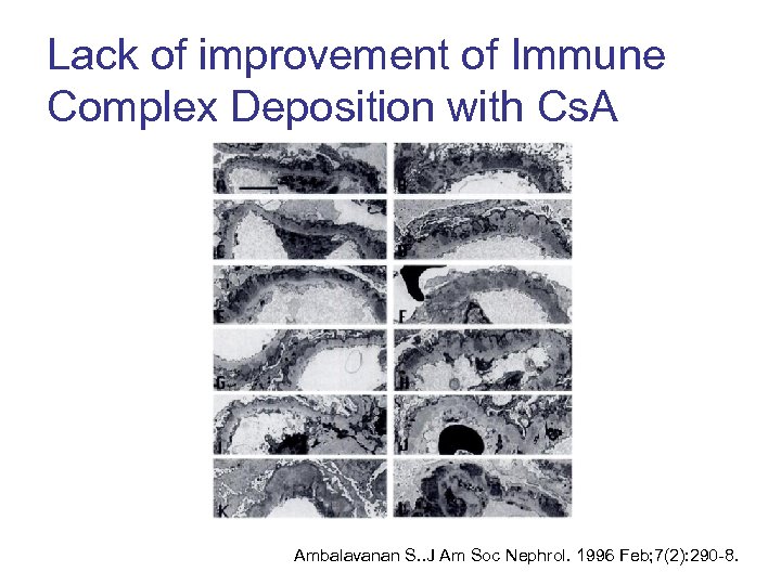 Lack of improvement of Immune Complex Deposition with Cs. A Ambalavanan S. . J