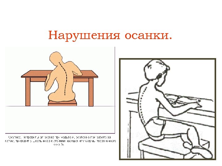 Нарушения осанки. 