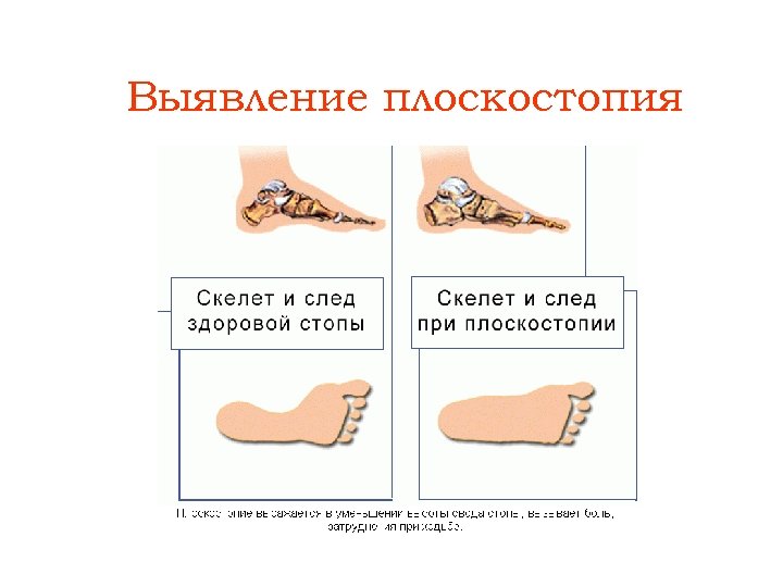 Выявление плоскостопия 