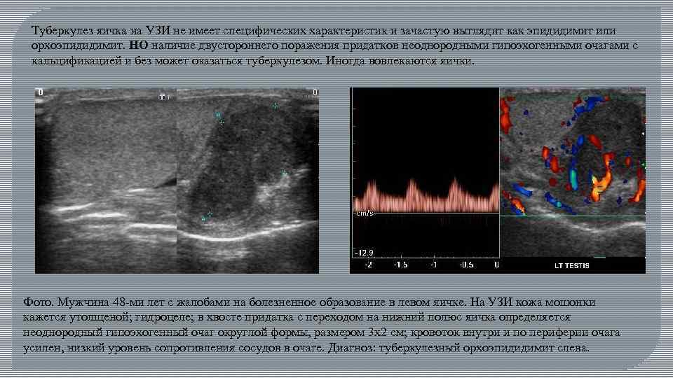 Туберкулез яичка на УЗИ не имеет специфических характеристик и зачастую выглядит как эпидидимит или