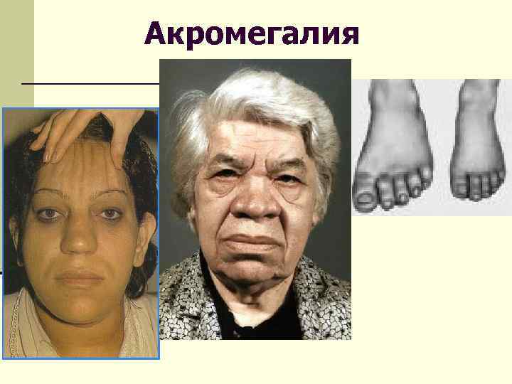 Акромегалия 