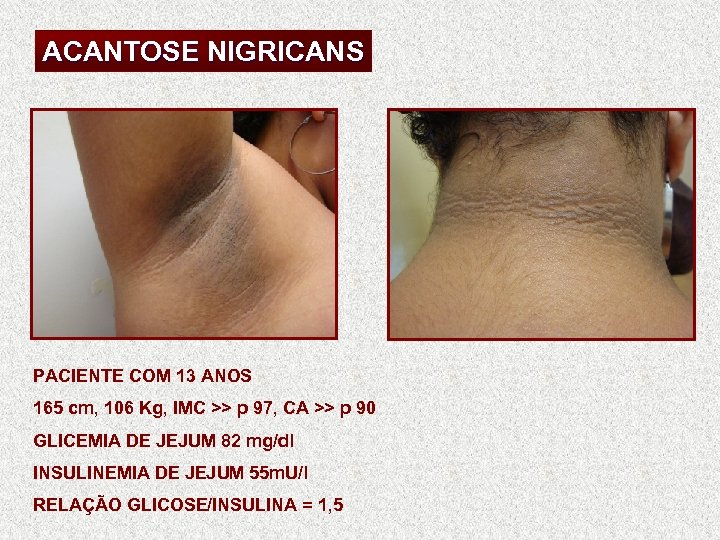 ACANTOSE NIGRICANS PACIENTE COM 13 ANOS 165 cm, 106 Kg, IMC >> p 97,