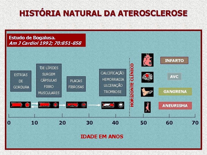 HISTÓRIA NATURAL DA ATEROSCLEROSE Estudo de Bogalusa. Am J Cardiol 1992; 70: 851 -858