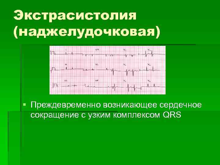 Экстрасистолия (наджелудочковая) § Преждевременно возникающее сердечное сокращение с узким комплексом QRS 