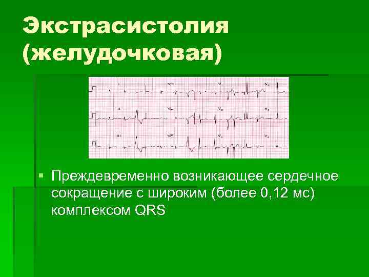 Экстрасистолия (желудочковая) § Преждевременно возникающее сердечное сокращение с широким (более 0, 12 мс) комплексом