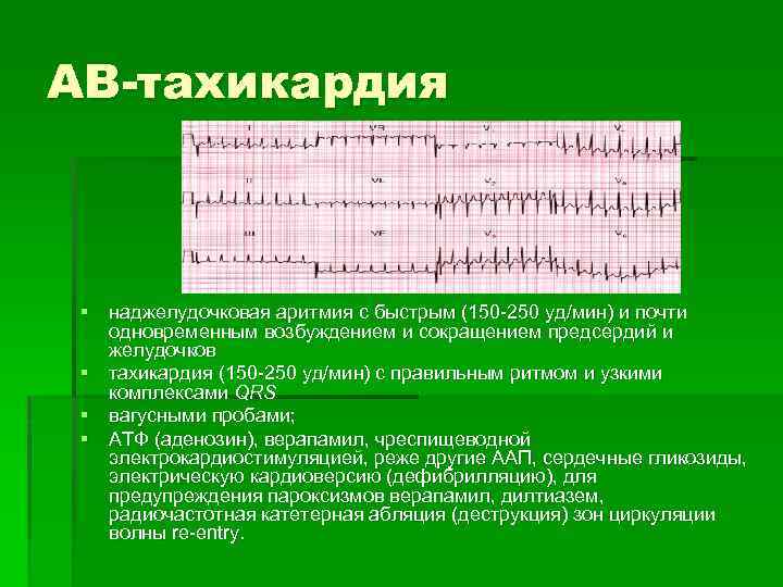 АВ-тахикардия § наджелудочковая аритмия с быстрым (150 -250 уд/мин) и почти одновременным возбуждением и