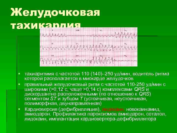 Желудочковая тахикардия § тахиаритмия с частотой 110 (140)– 250 уд/мин, водитель ритма которой располагается