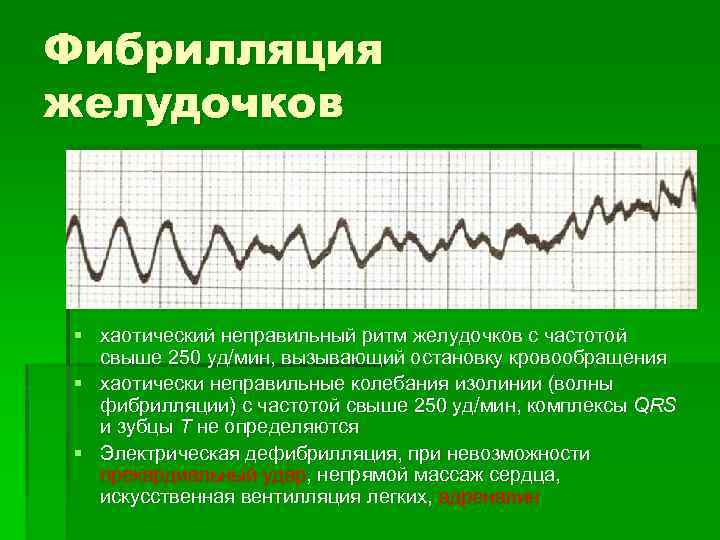 Фибрилляция желудочков § хаотический неправильный ритм желудочков с частотой свыше 250 уд/мин, вызывающий остановку