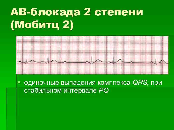 АВ-блокада 2 степени (Мобитц 2) § одиночные выпадения комплекса QRS, при стабильном интервале PQ