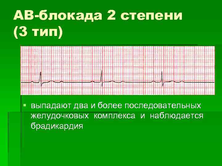 АВ-блокада 2 степени (3 тип) § выпадают два и более последовательных желудочковых комплекса и