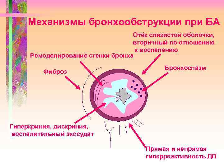 Механизмы бронхообструкции при БА Отёк слизистой оболочки, вторичный по отношению к воспалению Ремоделирование стенки