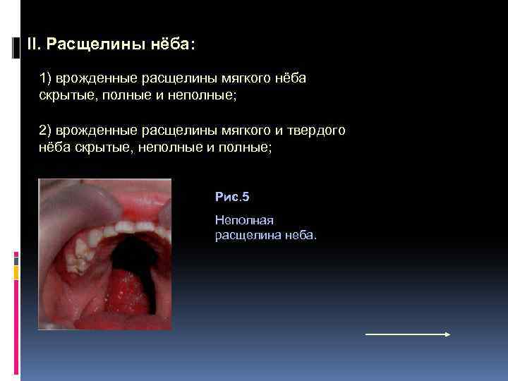 II. Расщелины нёба: 1) врожденные расщелины мягкого нёба скрытые, полные и неполные; 2) врожденные